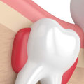 The Benefits of Wisdom Tooth Extraction: Why You Should Consider Removing Your Wisdom Teeth