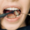 Finding The Top-Rated Dentist For Wisdom Teeth Removal In Waco: Your Ultimate Guide
