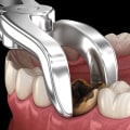 How Long Does It Take to Extract 4 Wisdom Teeth?