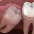 Everything You Need to Know About Wisdom Teeth Removal