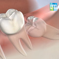 How Long Does Wisdom Teeth Removal Take with Anesthesia? A Comprehensive Guide