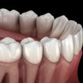 The Risks of Delaying Wisdom Teeth Removal