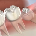 How Long Do Side Effects of Wisdom Teeth Removal Last? A Comprehensive Guide