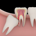 Navigating Wisdom Tooth Removal In Sydney: What You Need To Know