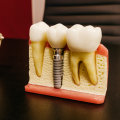 Why Opting For The Best Dental Implants Matters For Wisdom Teeth Removal In Austin