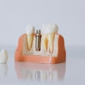 The Benefits Of Bone Grafting For Wisdom Tooth Removal In London
