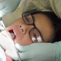 What is the Process for Wisdom Teeth Removal? - An Expert's Guide