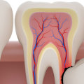 What are the Side Effects of Wisdom Teeth Removal?