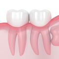 What to Know Before Going in for Wisdom Teeth Removal