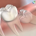 Beyond The Pull: Understanding Wisdom Teeth Extraction In San Diego, CA