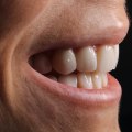 Transform Your Smile With Porcelain Veneers After Wisdom Teeth Removal In Austin