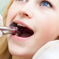 What Type of Anesthesia is Used for Wisdom Teeth Removal? - An Expert's Guide