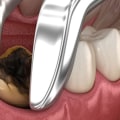 Recovery Time After Wisdom Teeth Removal: What to Expect