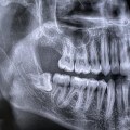 Tiny Teeth, Big Decisions: Wisdom Teeth Removal And Children's Dentistry In McGregor, TX