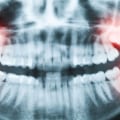 The Pros and Cons of Wisdom Tooth Extraction: What You Need to Know