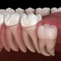 The Long-Term Benefits of Wisdom Teeth Removal