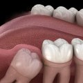 Should You Remove All 4 Wisdom Teeth at Once? - An Expert's Perspective