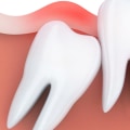 How Long Does It Take for the Pain to Subside After Wisdom Teeth Removal?