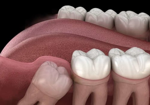 Should You Remove All Your Wisdom Teeth at Once? - An Expert's Perspective