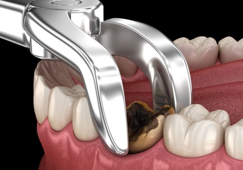 How Long Does It Take to Extract 4 Wisdom Teeth?