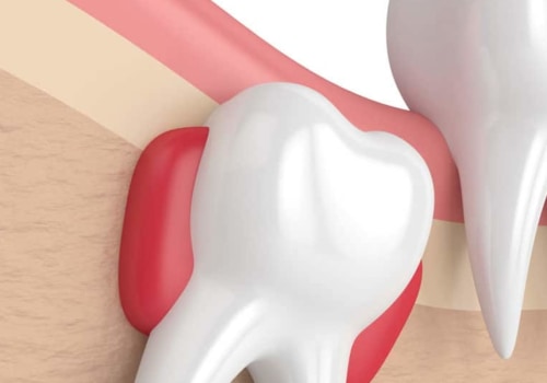 The Benefits of Wisdom Teeth Removal: What You Need to Know