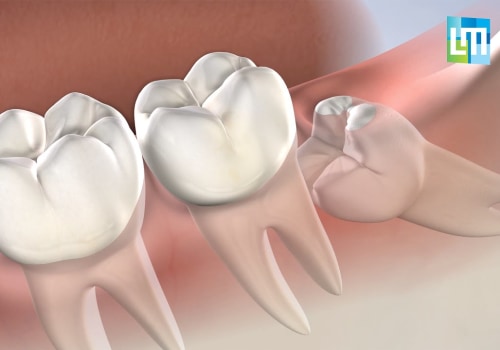 How Long Does Wisdom Teeth Removal Take with Anesthesia? A Comprehensive Guide