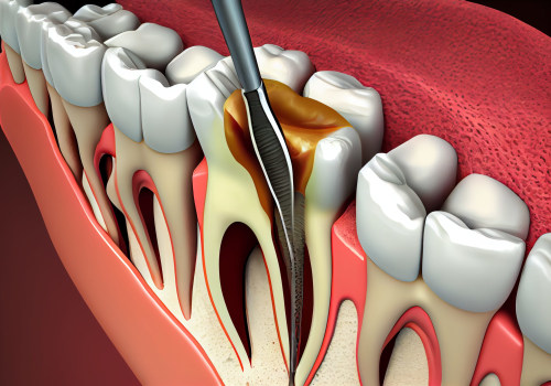Spring Branch Dental Implants: A Seamless Solution for Post-Wisdom Teeth Removal