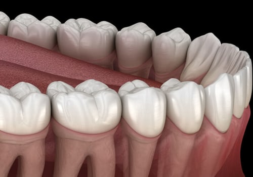 The Risks of Delaying Wisdom Teeth Removal