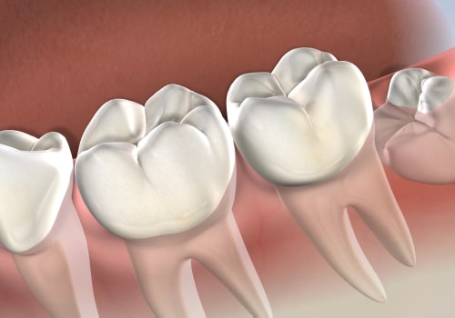 How Long Do Side Effects of Wisdom Teeth Removal Last? A Comprehensive Guide