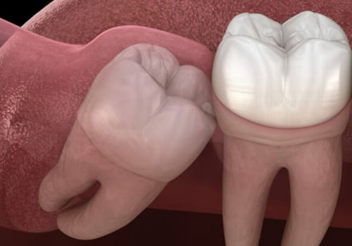 Everything You Need to Know About Wisdom Teeth Removal