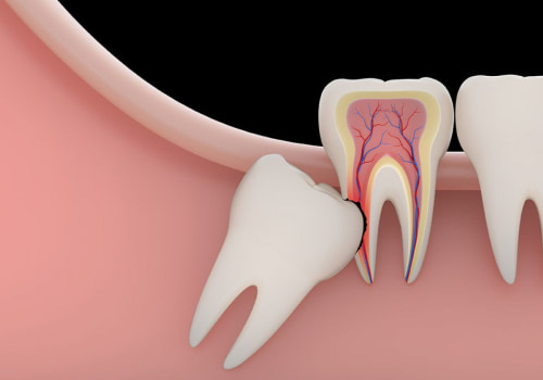 Navigating Wisdom Tooth Removal In Sydney: What You Need To Know