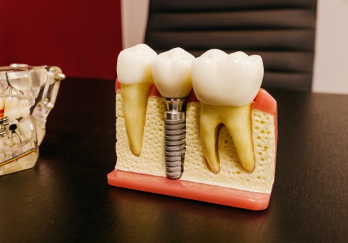 Why Opting For The Best Dental Implants Matters For Wisdom Teeth Removal In Austin