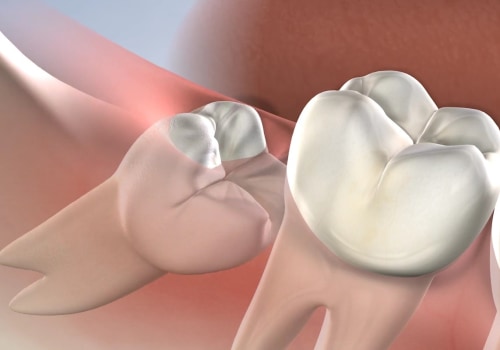 Why is Wisdom Tooth Extraction So Painful? A Comprehensive Guide