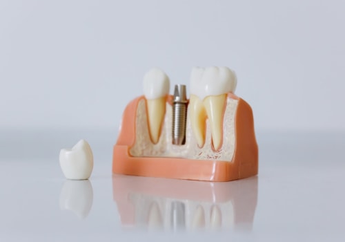 The Benefits Of Bone Grafting For Wisdom Tooth Removal In London