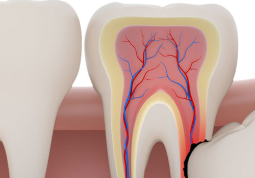 What are the Side Effects of Wisdom Teeth Removal?