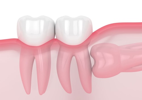 What to Know Before Going in for Wisdom Teeth Removal