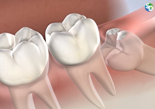 Beyond The Pull: Understanding Wisdom Teeth Extraction In San Diego, CA