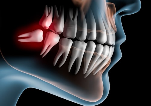 From Wisdom Teeth Woes To Radiant Smiles: Cosmetic Dentistry Solutions In Pflugerville, TX
