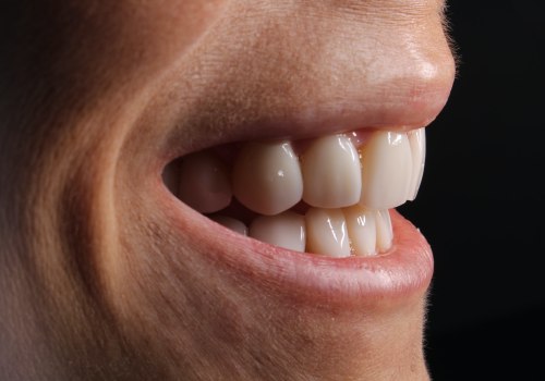 Transform Your Smile With Porcelain Veneers After Wisdom Teeth Removal In Austin