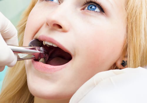 What Type of Anesthesia is Used for Wisdom Teeth Removal? - An Expert's Guide