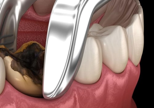 Recovery Time After Wisdom Teeth Removal: What to Expect