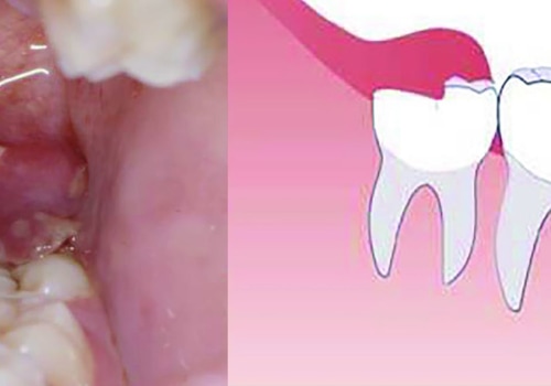 Is Wisdom Tooth Extraction Painful? An Expert's Perspective