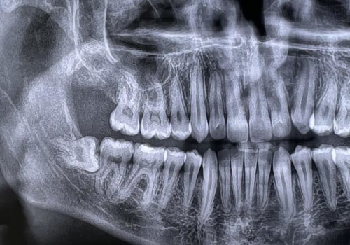 Tiny Teeth, Big Decisions: Wisdom Teeth Removal And Children's Dentistry In McGregor, TX