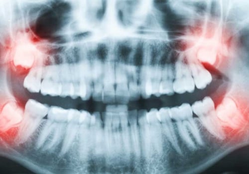 The Pros and Cons of Wisdom Tooth Extraction: What You Need to Know