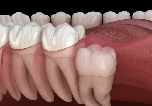 The Long-Term Benefits of Wisdom Teeth Removal