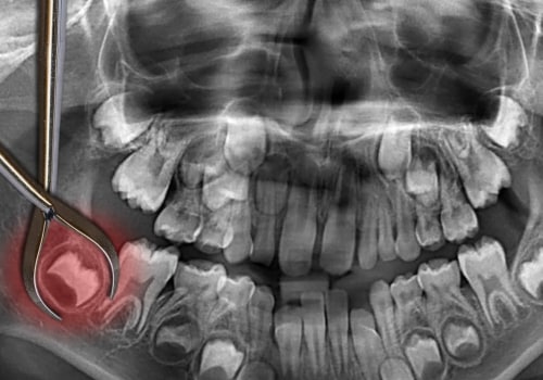 How Long Does It Take to Get All 4 Wisdom Teeth Removed?