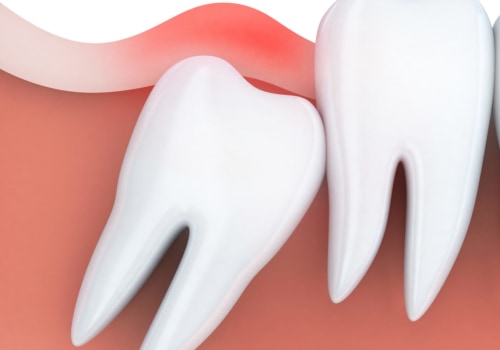 How Long Does It Take for the Pain to Subside After Wisdom Teeth Removal?